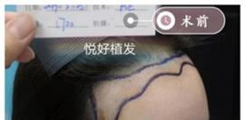 得知四川植发哪里好后发际线后移的我成功做了植发手术