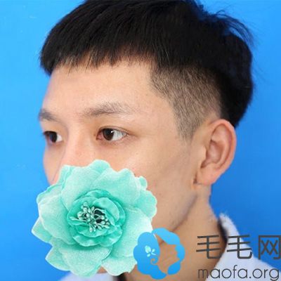 来合肥蝶之星植发做眉毛种植