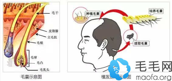 原来大家常说头发种植后太可怕竟然是因为这6大植发的危害