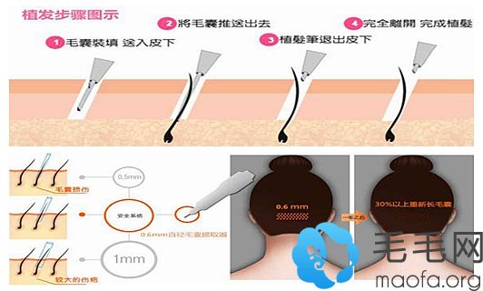 南阳华美FUE+FM无痕植发术