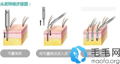 种头发手术过程步骤图