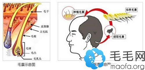 毛发移植的原理图解