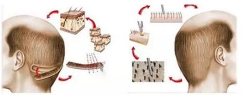 FUT植发技术原理