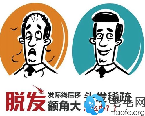 “植”得一看!哪些脱发人群不适合做FUE毛囊移植手术