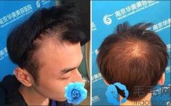通过“拆东墙补西墙”我在头顶/额角脱发处种植了2300株头发