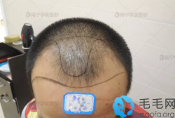 见识了抖音植发效果我在南宁做了额角种植解决