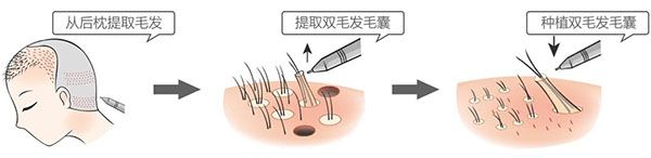 头发种植手术流程图