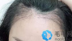 我出现二级脱发发际线后移，种植1600单位做调整