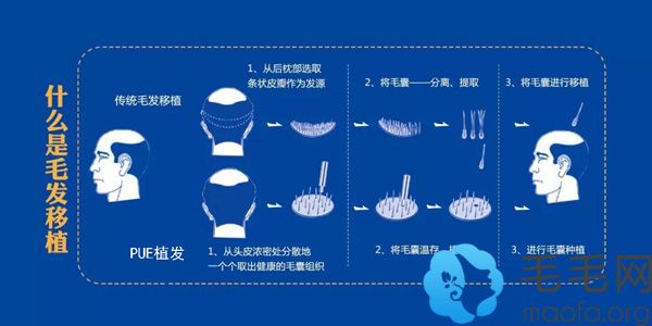 先进的PUE植发技术