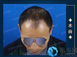 M型脱发程序员,做男士发际线艺术种植20天后变这样!