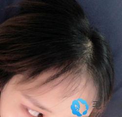 我产后前额脱发去种了发际线,很高兴长出的头发还可以烫染