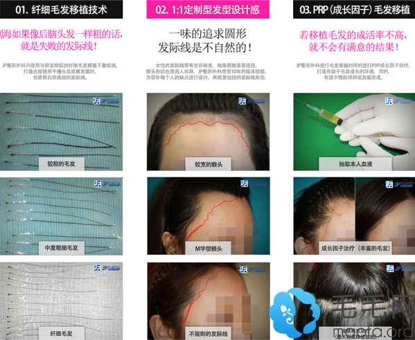 韩国JP毛发移植医院MSD植发技术优势