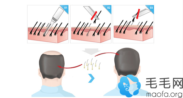 合肥崔劲松毛发移植过程