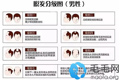 脱发通常分为7个级别