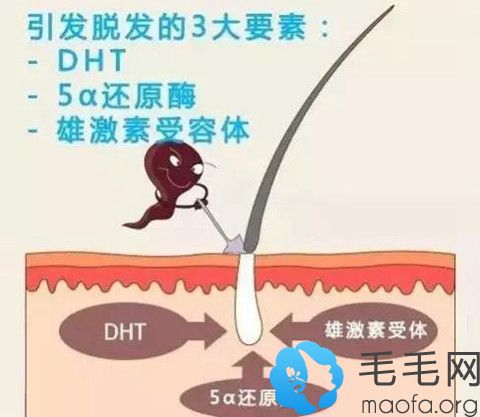 遗传性脱发主要受雄激素影响