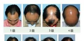 用女生头顶加密效果图来论证!头发加密为什么比植发贵