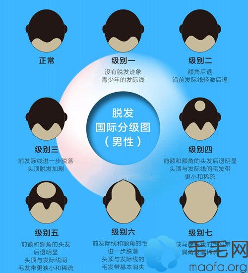 男性1-7级脱发分级图