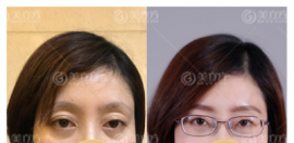 被女生植眉后效果图吸引,一问在这做种植眉毛仅需要8800元起