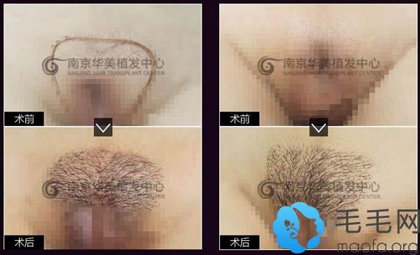 南京华美女士比基尼私密种植效果图