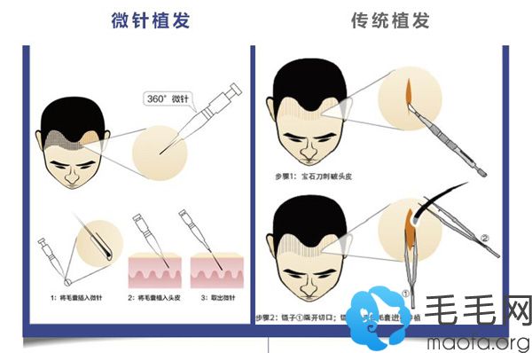pse微针植发和fue无痕种植的技术原理区别
