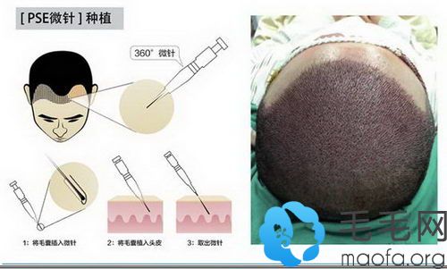 pse微针植发技术