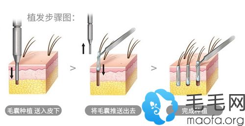 FUN植发手术操作步骤图