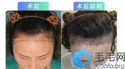 这位佛山的妹子用纳米fun植发技术解决了发际线后移的问题