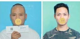 谁说植发只能维持两到三年太坑人?我种头发都3年了还好好!