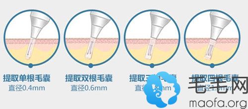 院内擅长头顶加密种植