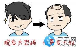 用他头顶加密植发前后效果对比图来告诉你:手术容易失败吗?