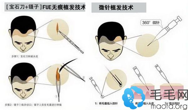 微针植发是骗局?但是我用PST微针植发技术种头发一年变化…