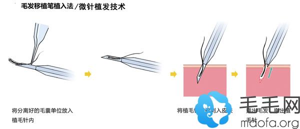 微针植发技术实操演示