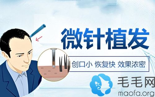 PUE无痕植发技术的原理