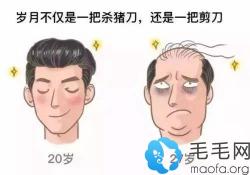 亲身经历了头发加密种植才知道,植发效果不止是可以保持5年