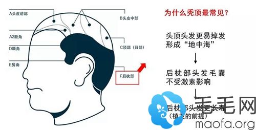 毛发移植技术的原理