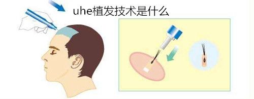 UHE和AHT植发技术哪个好?uhe植发技术多少钱?