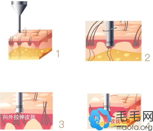 华美植发与国外毛发机构合作