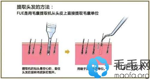 FUE无痕植发技术第三代和第四代