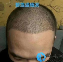 我前额发际线高头发稀疏,靠植发的办法治脱后摆脱发带遮挡