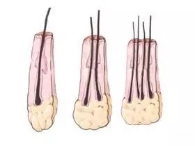 一个毛囊中有1-4根头发