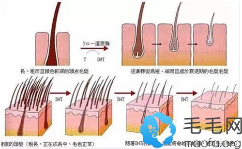 导致脂溢性脱发的原因