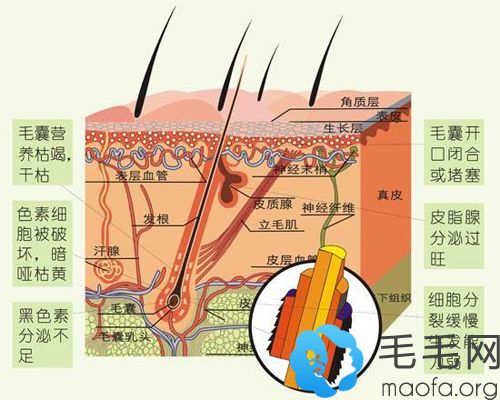 脂溢性脱发的病变过程