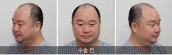 韩国出名植发医院案例:6级脱发加密植发5500根一年后效果