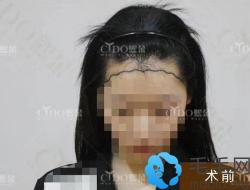 植发际线后后悔了!早知道这样能改善高发际线我就不纹发了