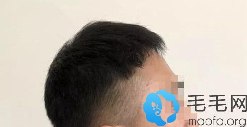 植发二次修复六个月后效果