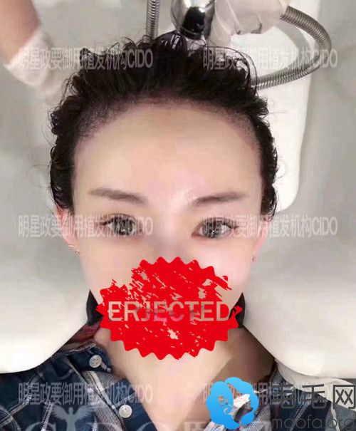 发际线种植术后10天效果图