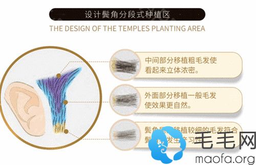 种植鬓角的设计特点