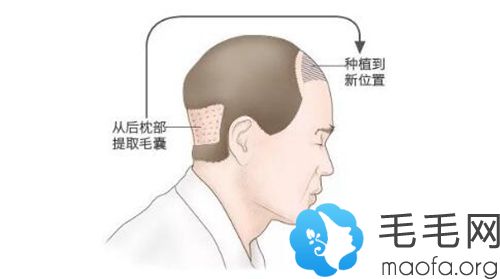 毛发移植的手术原理