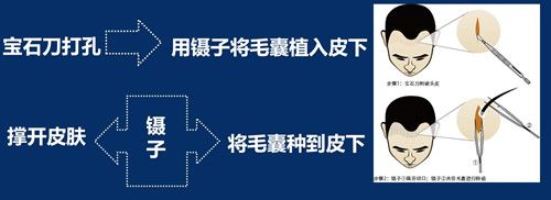 被骗用已经淘汰的宝石刀做植发怎么办?它会伤害自身毛囊吗?