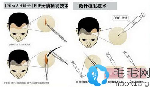 微针植发和宝石刀植发的区别